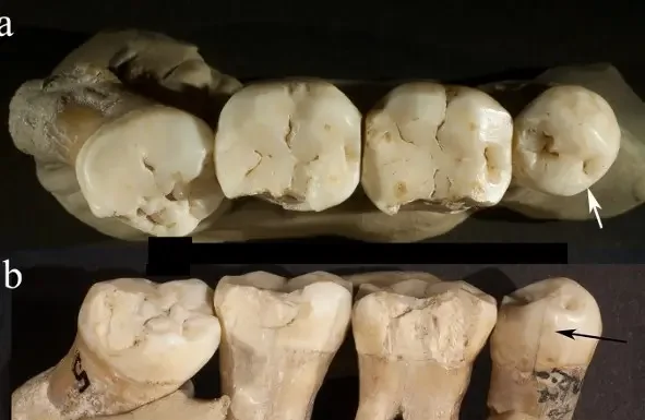 Neandertal Fez Tratamento Dental Há 130 Mil Anos