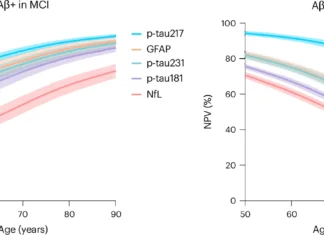 Exame de Sangue Prevê Alzheimer Com 30 Anos de Antecedência