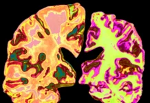 Cientistas: Perda de Lítio Está Associado a Alzheimer