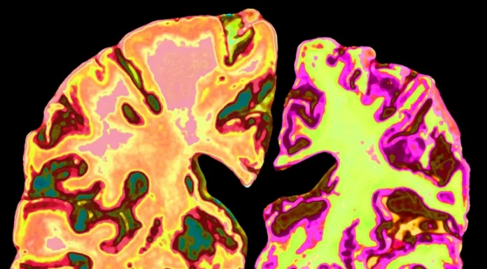 Cientistas: Perda de Lítio Está Associado a Alzheimer