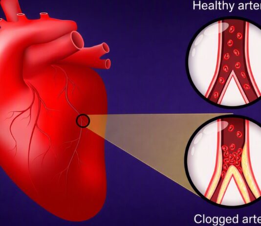 Quatro Milhões Morrem Por Ano de Cardiopatia Isquêmica Por Má Alimentação |Nature & Space