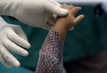 Tecnologia da UFC: Ceará, Brasil, Terá Primeira Fábrica do Mundo de Pele de Tilápia Para Queimaduras | Nature & Space