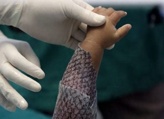 Tecnologia da UFC: Ceará, Brasil, Terá Primeira Fábrica do Mundo de Pele de Tilápia Para Queimaduras | Nature & Space