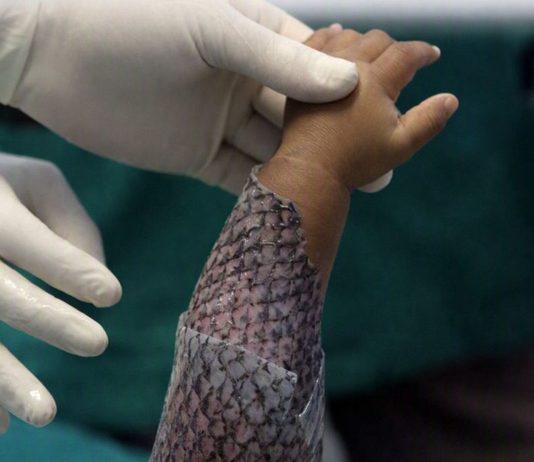 Tecnologia da UFC: Ceará, Brasil, Terá Primeira Fábrica do Mundo de Pele de Tilápia Para Queimaduras | Nature & Space